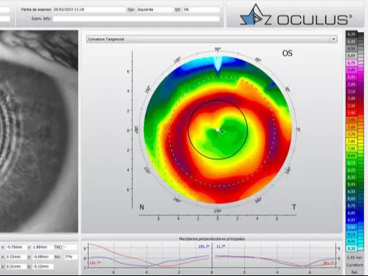 Topografia Corneal